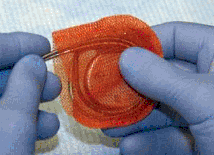 Image: The AIGISRx Flat Antibacterial Envelope (photo courtesy TYRX).